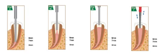 Duo-Gun Cordless Backfill Obturation Device